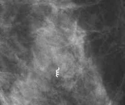 Clipagem de tumor de mama Rio do Sul - Ultraclinica Ultrassonografia
